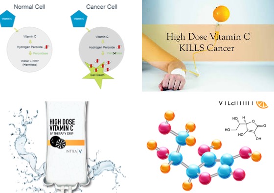 Update Update #12:  Does High Dose IV Vitamin C therapy Kill Cancer Cells? Image