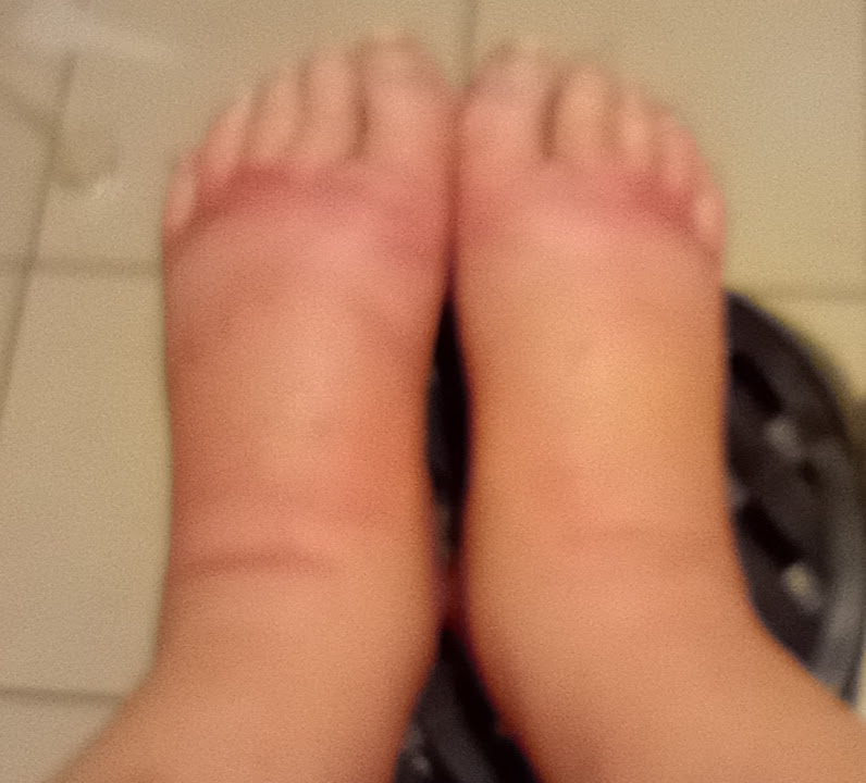 Update Update #1 What if it was your Feet? Image