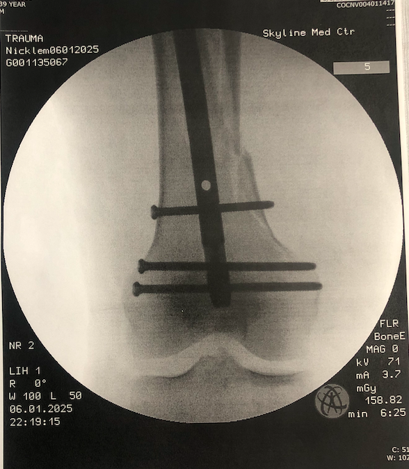 Update Update #6 June 11 by his wife, Cristina Image