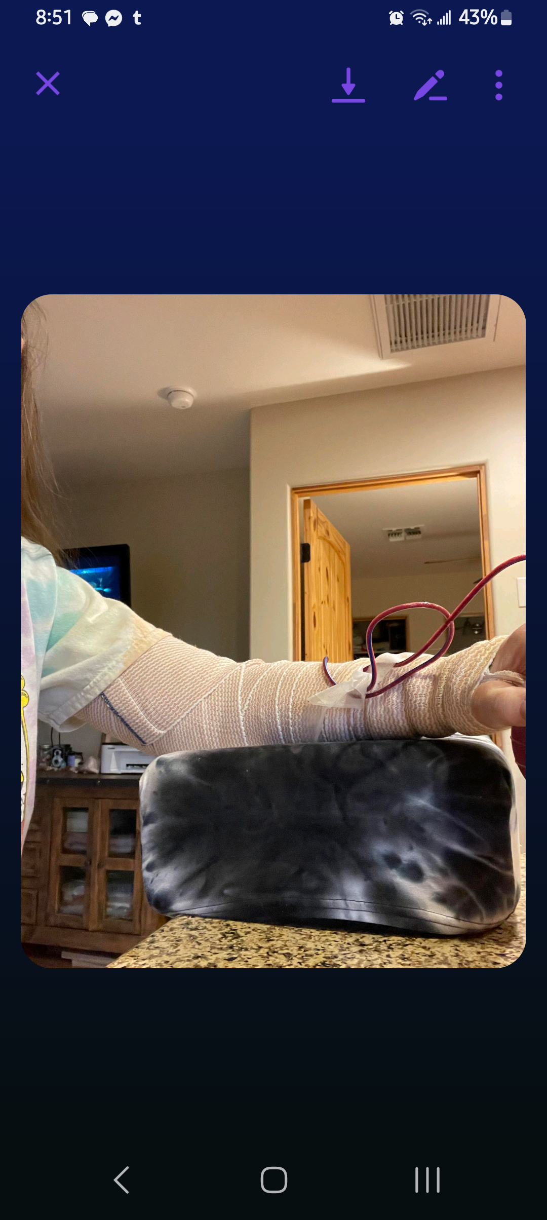 Update Update #11 FOURTH SURGERY Image