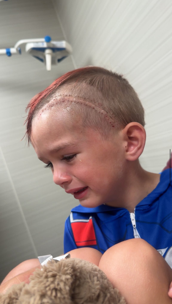 Update Update #1 Stitches removed! Image